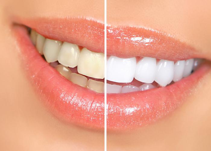 Why Teeth Whitening Is the Most Popular Cosmetic Service